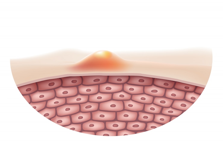 Vector acne skin