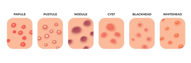 Vector acne types facial infections pimples and skin inflammation skincare face acne breakout dermatology epidermis disease recent vector set