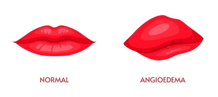 Vector angioedema atau edema bibir, pembengkakan alergi