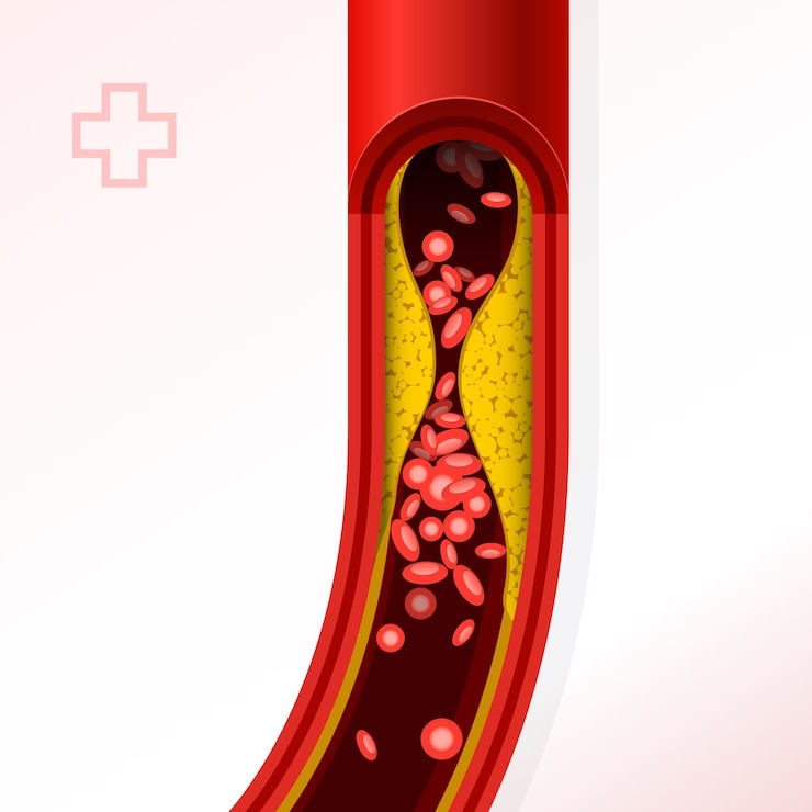 Vector bagian arteri dengan penumpukan kolesterol - kolesterol dan trombosis