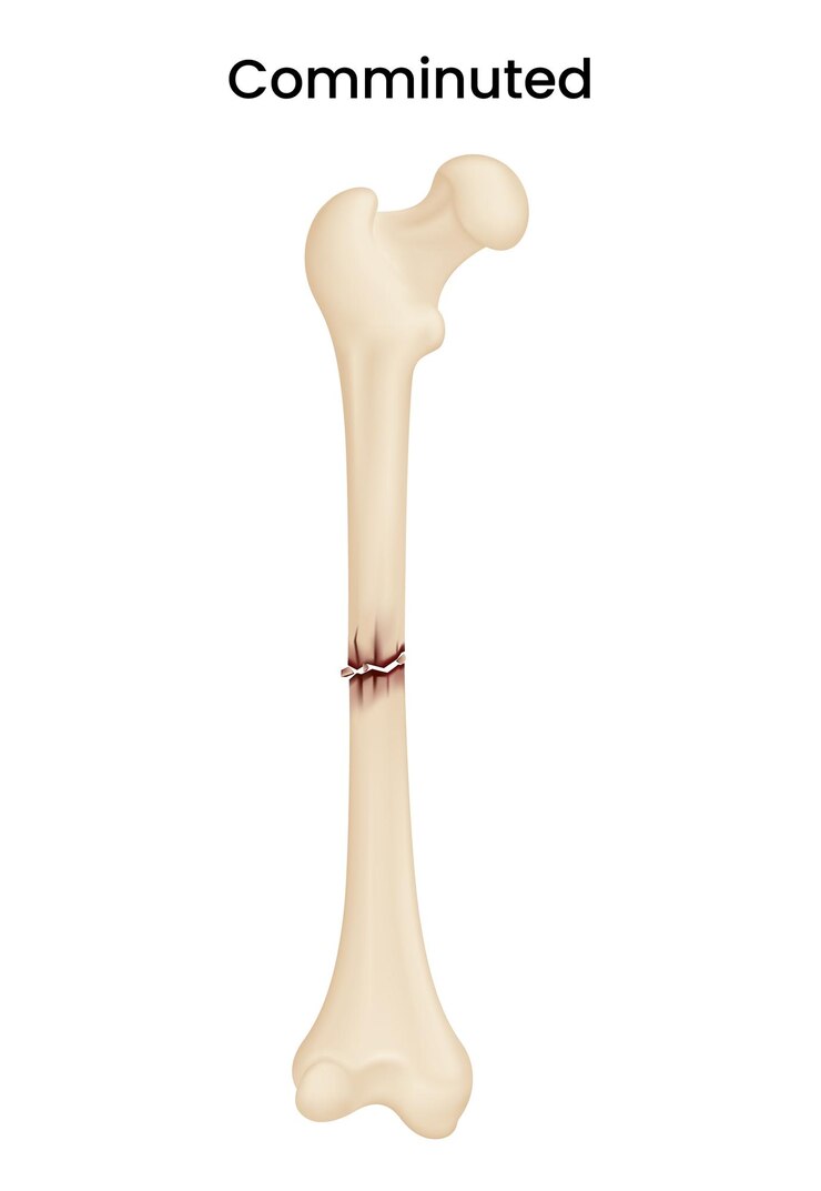 Vector causes of the comminuted fracture