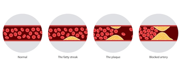 Cholesterol and atherosclerosis