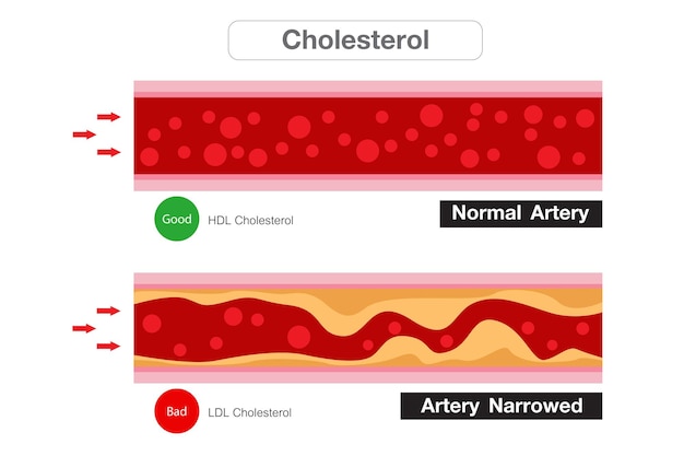 Cholesterol in artery health risk vector design
