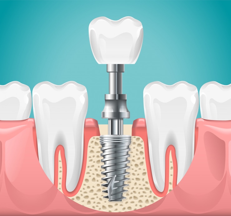 Vector dental surgery. tooth implant cut illustration. healthy teeth and dental implant, stomatology poster