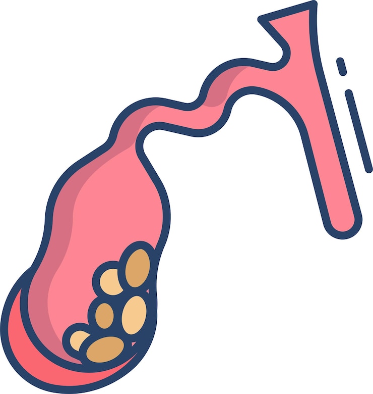 Vector gallbladder disease linear color illustration