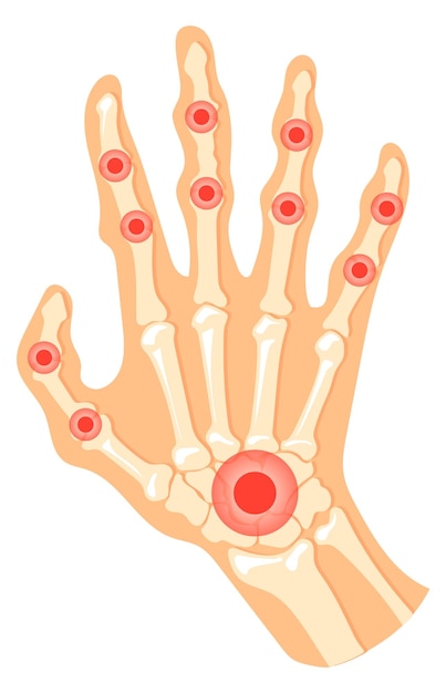 Hand joint pain Human palm ache red spot
