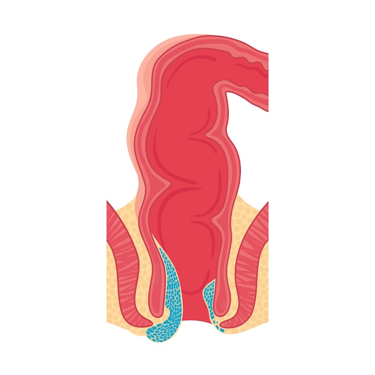 Vector hemorrhoids in the rectum vector illustration in cartoon style