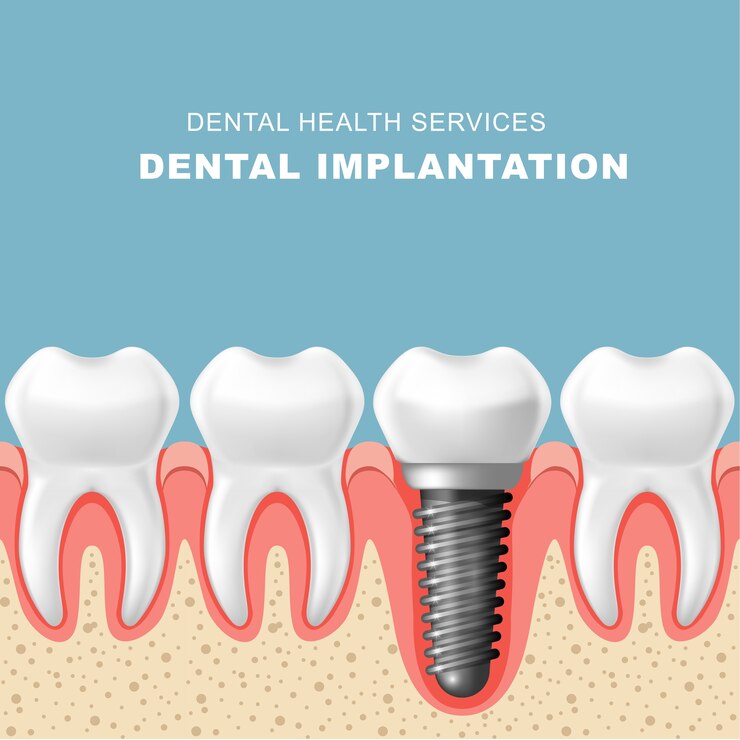 Vector implantasi gigi - deretan gigi di gusi dengan implan