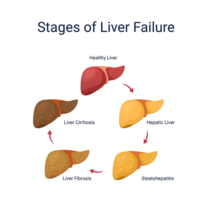 Vector liver diseases stage anatomy diagram vector illustration