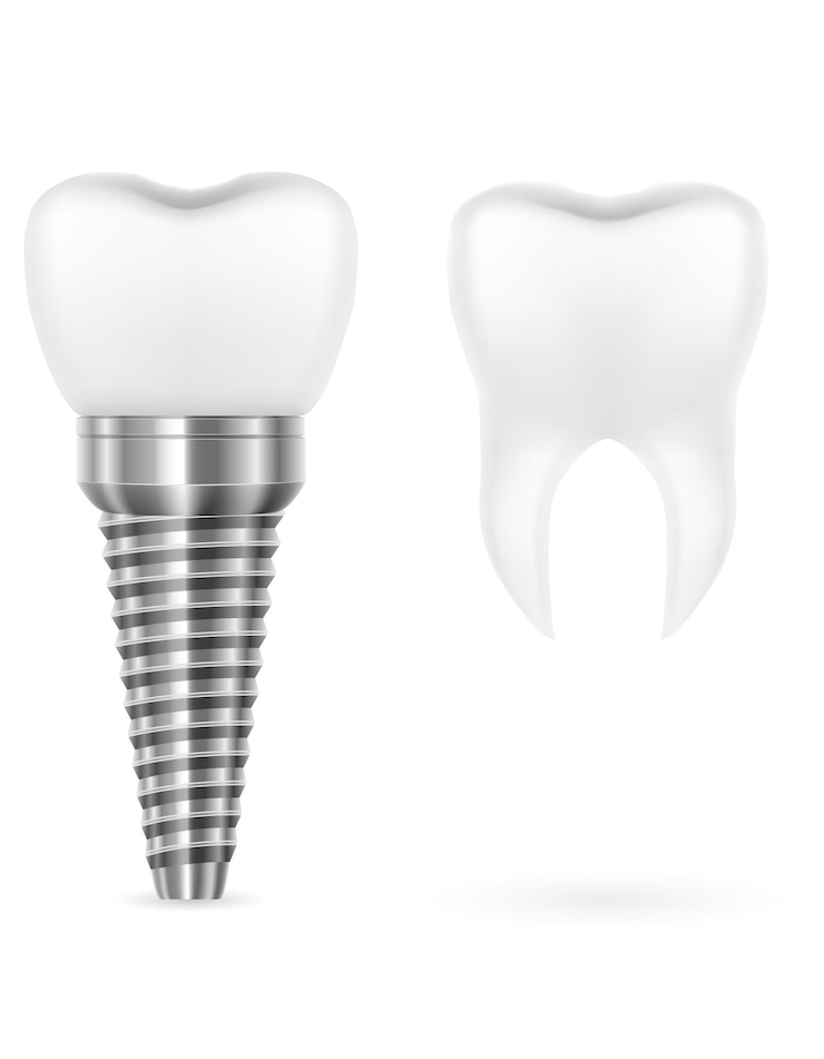 Vector metal human tooth implant vector illustration