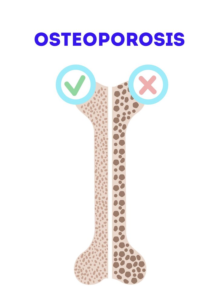 Osteoporosis vector illustration. Medical orthopaedic poster with an illustration of bones