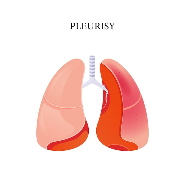 Pleurisy vector, illustration of pleurisy disease, vector design for medical
