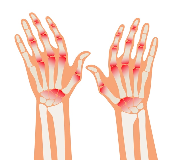 Rheumatoid Arthritis hands Pain in the human body Arthritis bone disease medical poster Finger arthritis vector illustration