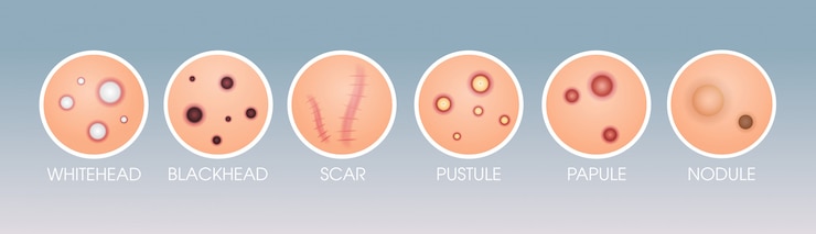 Vector set skin scar whitehead pustule blackhead papule pimples different acne types face pore comedones cosmetology skincare problems concept flat horizontal