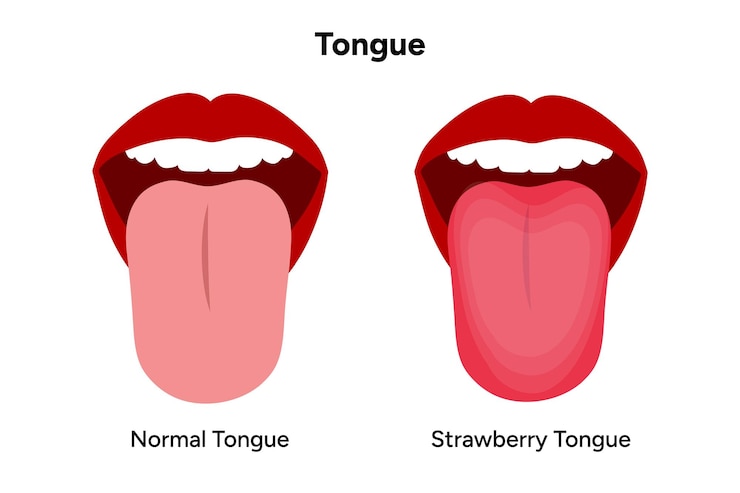 Vector strawberry tongue disease