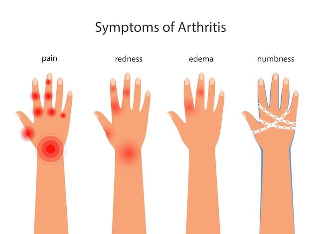 Symptoms of rheumatoid arthritis redness edema numbness Pain in the hands with autoimmune disease vector poster