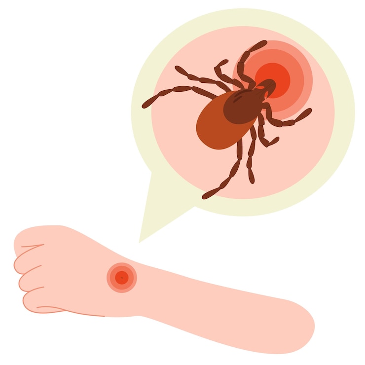 Vector the human hand with the tick bite tick bite handtick bite healthcare illustration