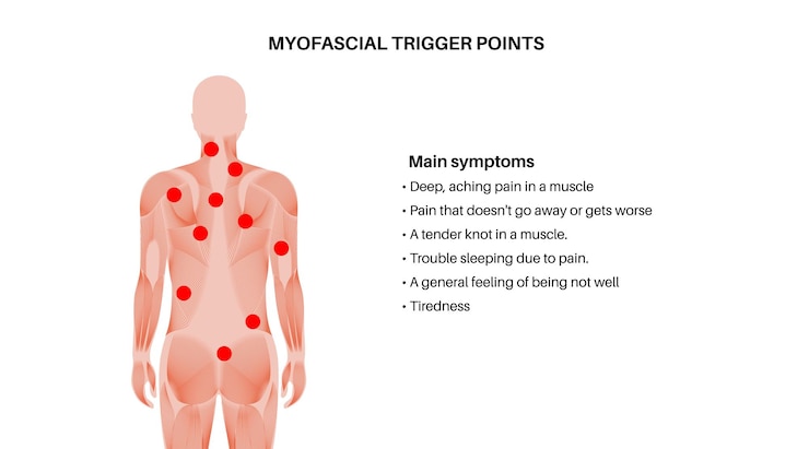 Vector titik picu myofascial