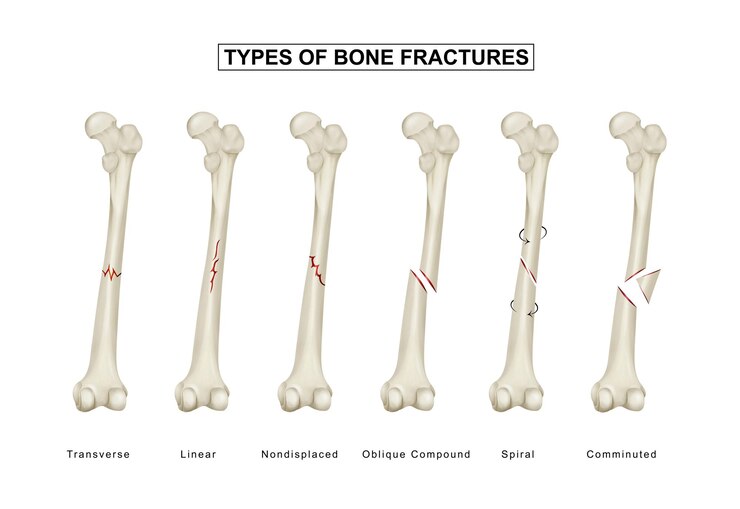 Vector types of bone fractures femoral shaft fracture