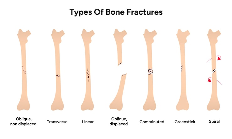 Vector types of bones fractures