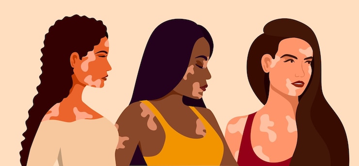 Vector vitiligo, tiga wanita muda dari ras berbeda dengan masalah kulit, penyakit kulit