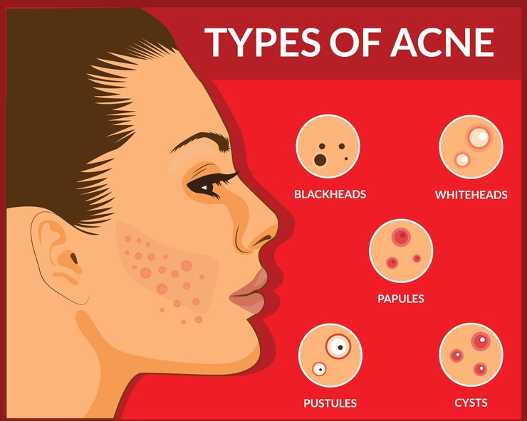 Vector young woman with skin problems pimple problems types of acne