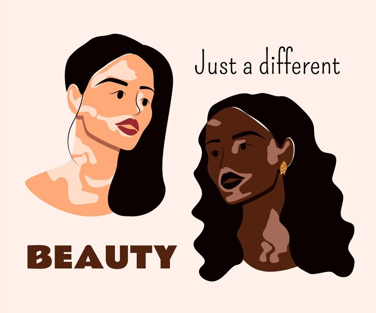 Vector young women live with vitiligo different beauty self love and vitiligo skin disease concept vector