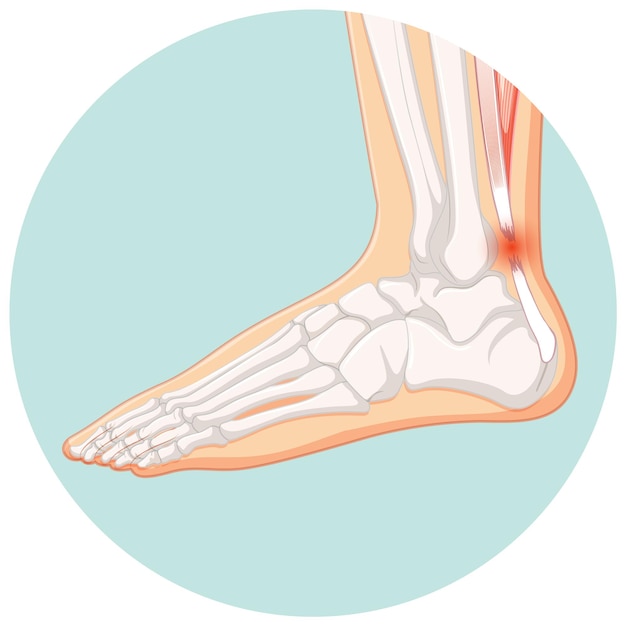 Kostenloser Vektor achillessehnenruptur in kreisschablone