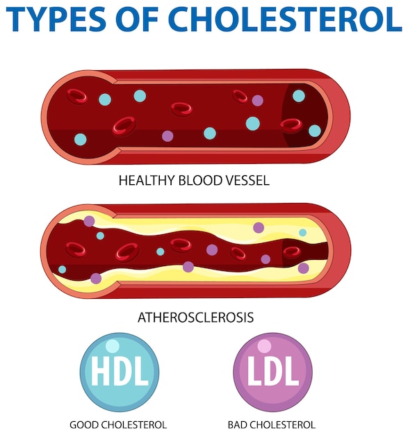 Arten von cholesterin hdl und ldl