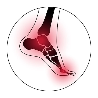 Arthritis fußgelenk. rheumatoide schmerzen in der flachen vektorillustration des beins