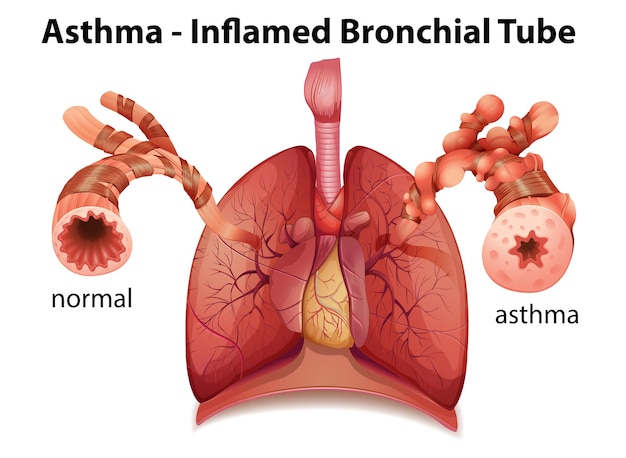 Kostenloser Vektor bronchialasthma