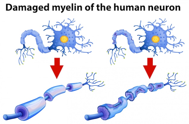 Kostenloser Vektor dammaged myelin des menschlichen neurons