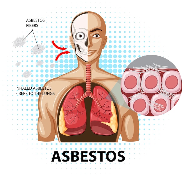 Diagramm, das asbestose in der lunge zeigt