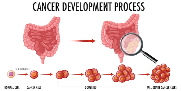 Kostenloser Vektor diagramm, das den krebsentwicklungsprozess zeigt