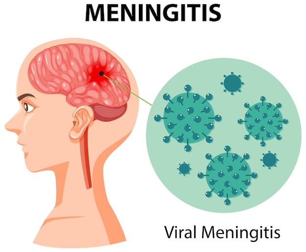 Kostenloser Vektor diagramm, das meningitis im menschlichen gehirn zeigt