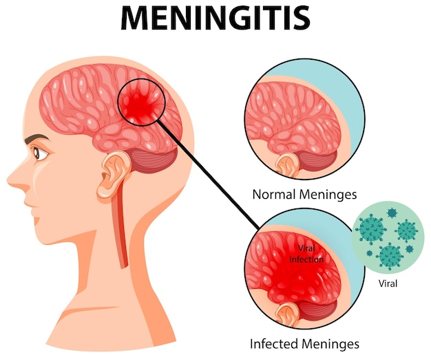 Diagramm, das Meningitis im menschlichen Gehirn zeigt