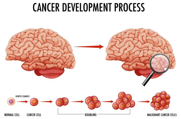 Diagramm, das menschliches Gehirn und Krebs zeigt