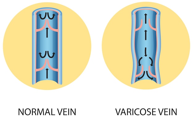 Kostenloser Vektor ein vergleich einer normalen vene mit einer krampfader