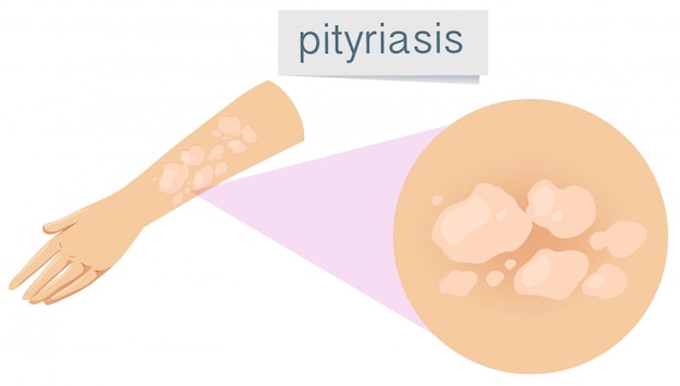 Kostenloser Vektor eine pityriasis auf der menschlichen haut