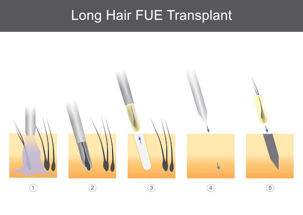 Fue-transplantationsillustration für lange haare für medizinische zwecke, die technische schritte der haartransplantation zeigt Premium Vektoren
