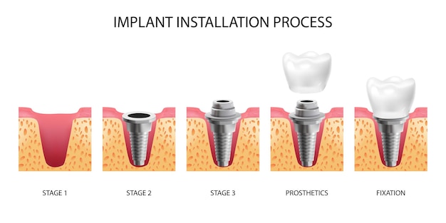 Fünf Stufen der Zahnimplantatinstallation realistisch isoliert