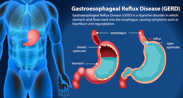 Kostenloser Vektor gastroösophageale refluxkrankheit gerd-diagramm