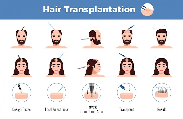 Haartransplantation für Männer und Frauen mit Infografiken im Operationsstadium auf Weiß