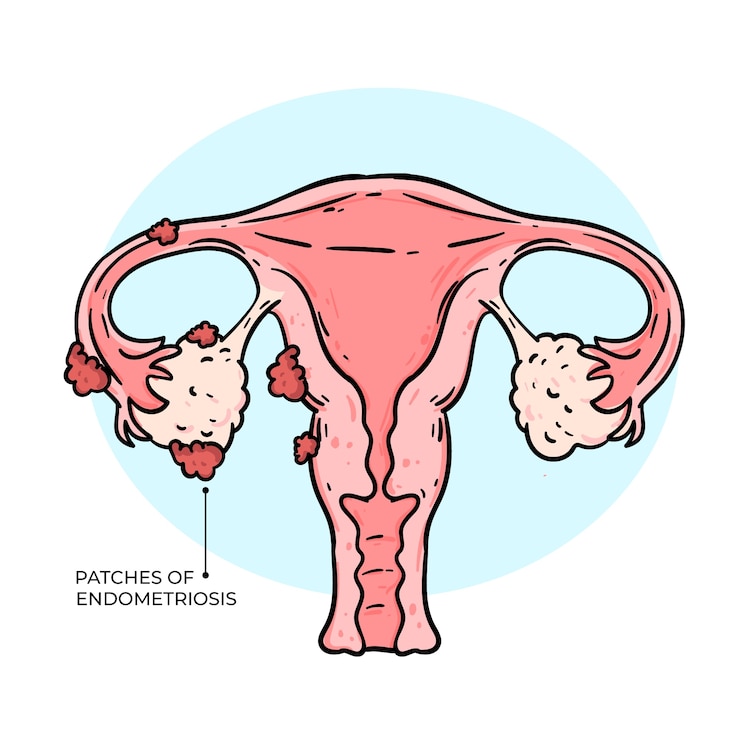 Kostenlose Vektor handgezeichnete endometriose-illustration