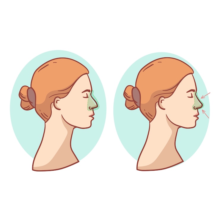 Kostenlose Vektor handgezeichnete rhinoplastik-illustration