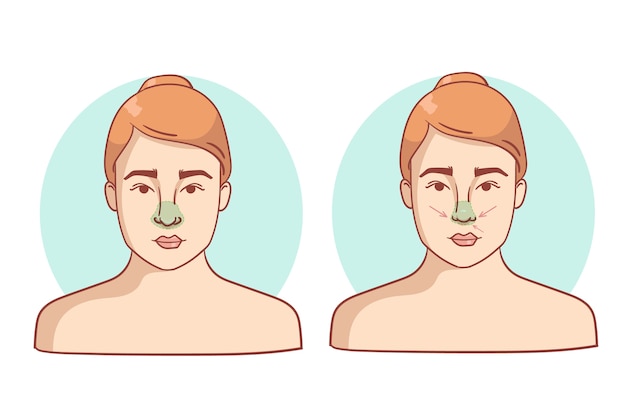 Handgezeichnete rhinoplastik-illustration