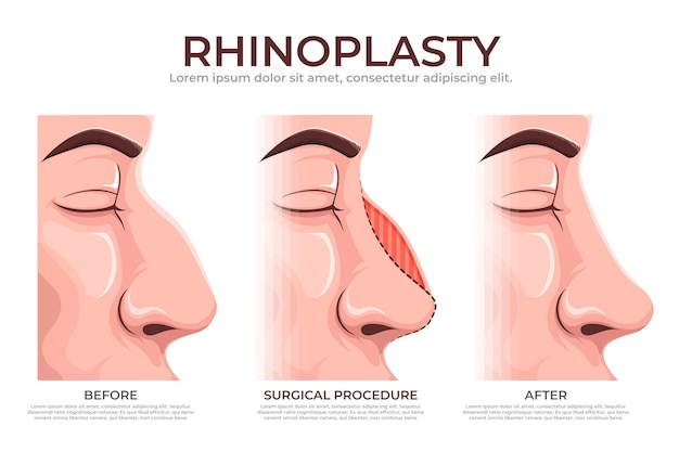 Kostenloser Vektor handgezeichnete rhinoplastik-infografik