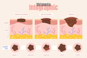 Kostenloser Vektor handgezeichnetes flaches design melanom infografik