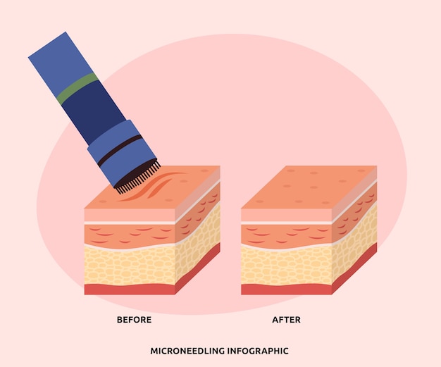 Kostenloser Vektor handgezeichnetes flaches design micro needling infografik