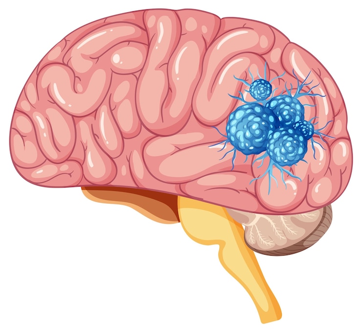 Kostenlose Vektor human brain with tumor vector illustration